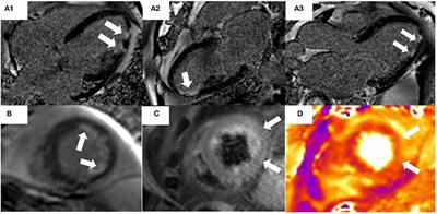 The Role of Cardiac Magnetic Resonance in Myocardial Infarction and Non-obstructive Coronary Arteries